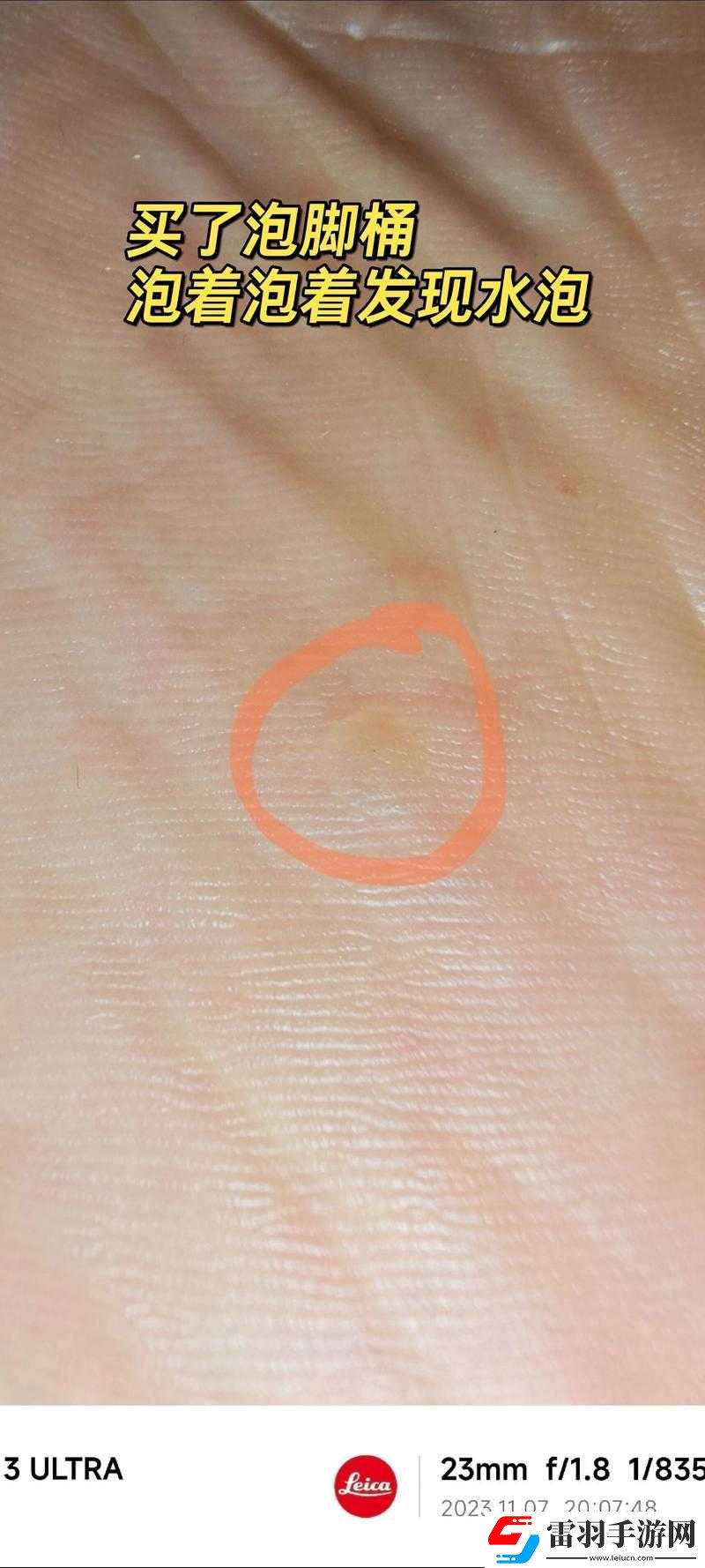 腳底長(zhǎng)了像水泡一樣的東西很癢該怎么辦如何解決